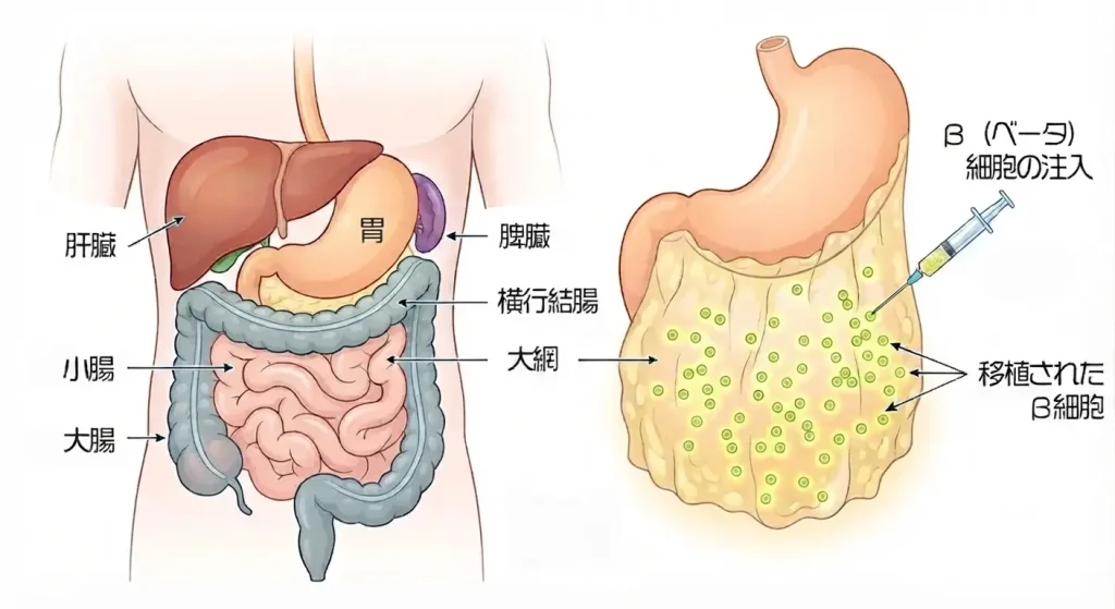 人間の腹部の解剖図と、大網へ移植されたβ細胞のイメージ図。左図は肝臓、胃、膵臓、横行結腸、小腸、大腸の配置を示し、右図は注射器を用いて大網へβ細胞が移植される様子を解説している。